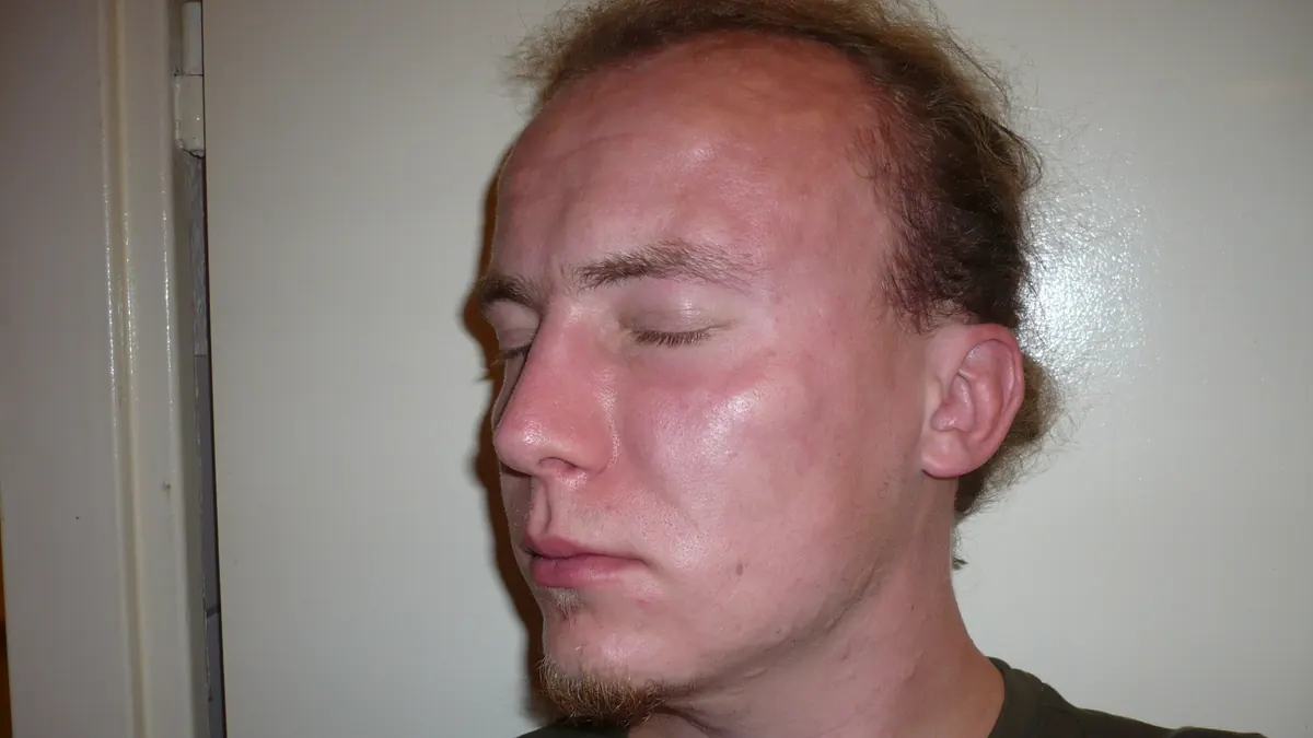 Rosto de um homem com inchaço (angioedema) nas pálpebras e nos lábios durante uma reação alérgica