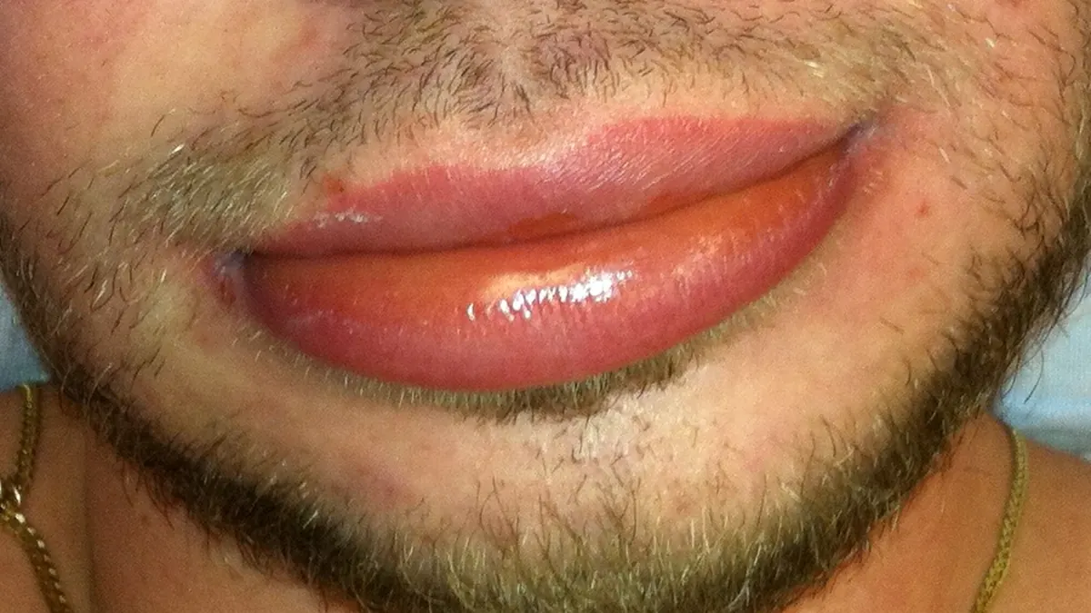 Lábio inferior de um homem jovem inchado por angioedema, liso e brilhante