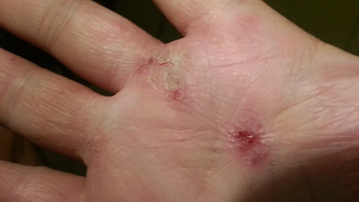 Palma da mão com pele seca, vermelha e duas pequenas feridas de eczema perto da base dos dedos