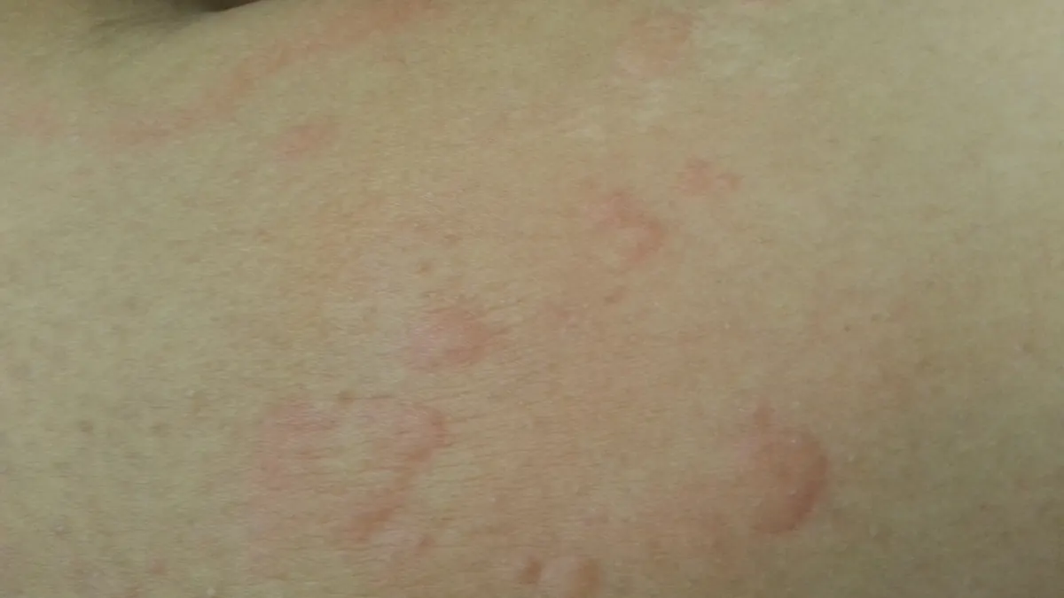 Pele com vergões avermelhados de urticária ao frio, depois de contato com o frio