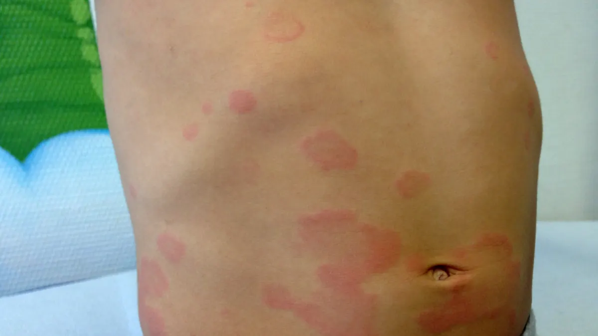 Barriga de criança com placas de urticária arredondadas, vermelhas e com bordas nítidas